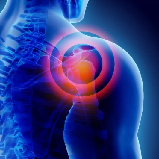 Rotator Cuff Tears/Pathology